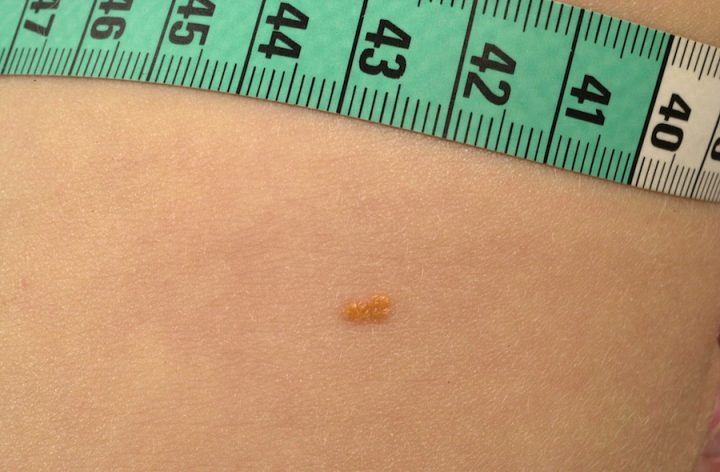 Juveniel xanthogranuloom Huidhuis